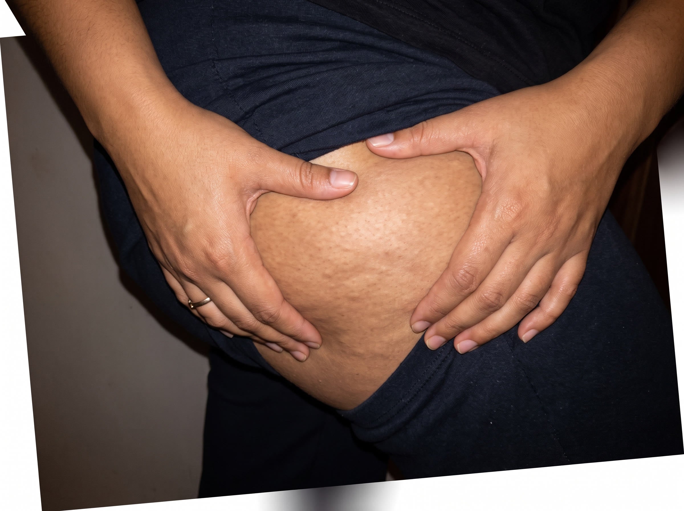 La celulitis no es grasa. Es estructura