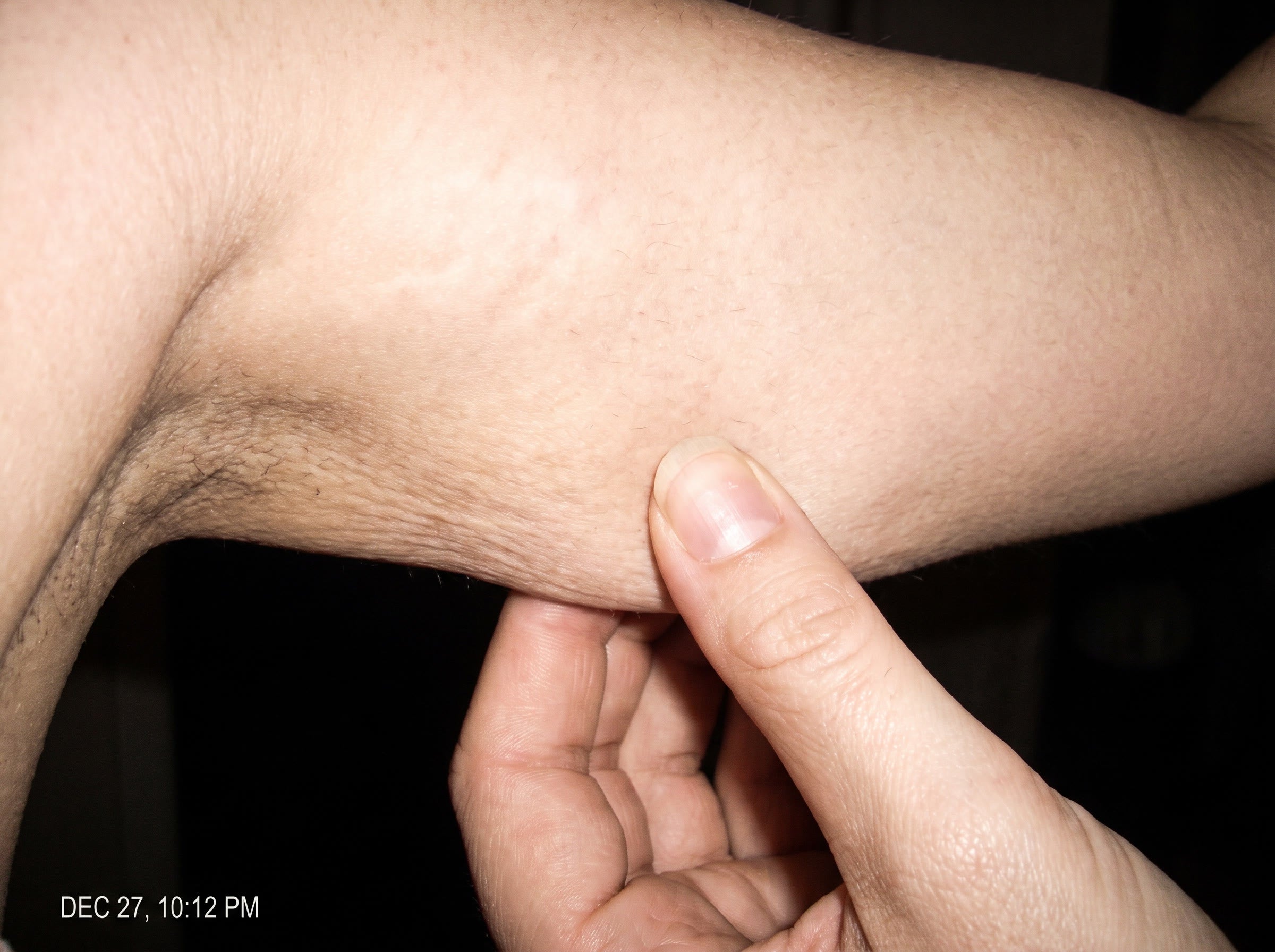 Loose skin is not a fat problem