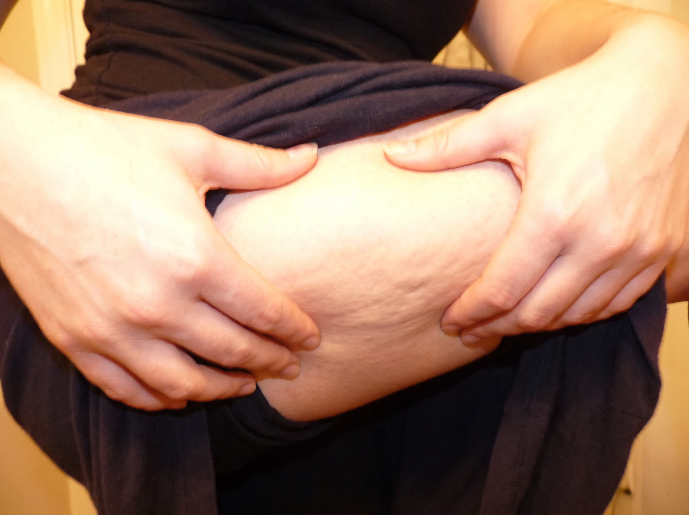 Cellulite was never a fat problem