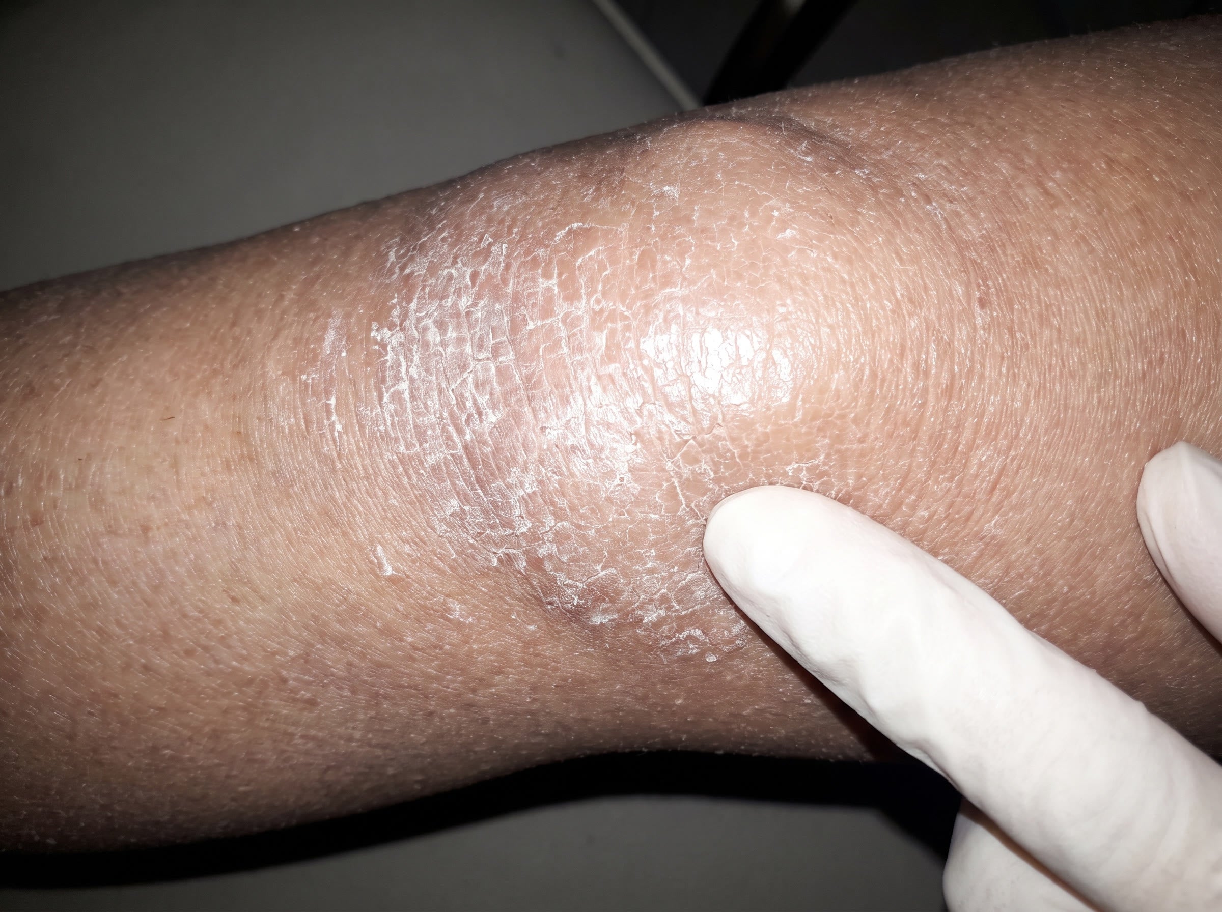 Dry skin makes every dimple look deeper