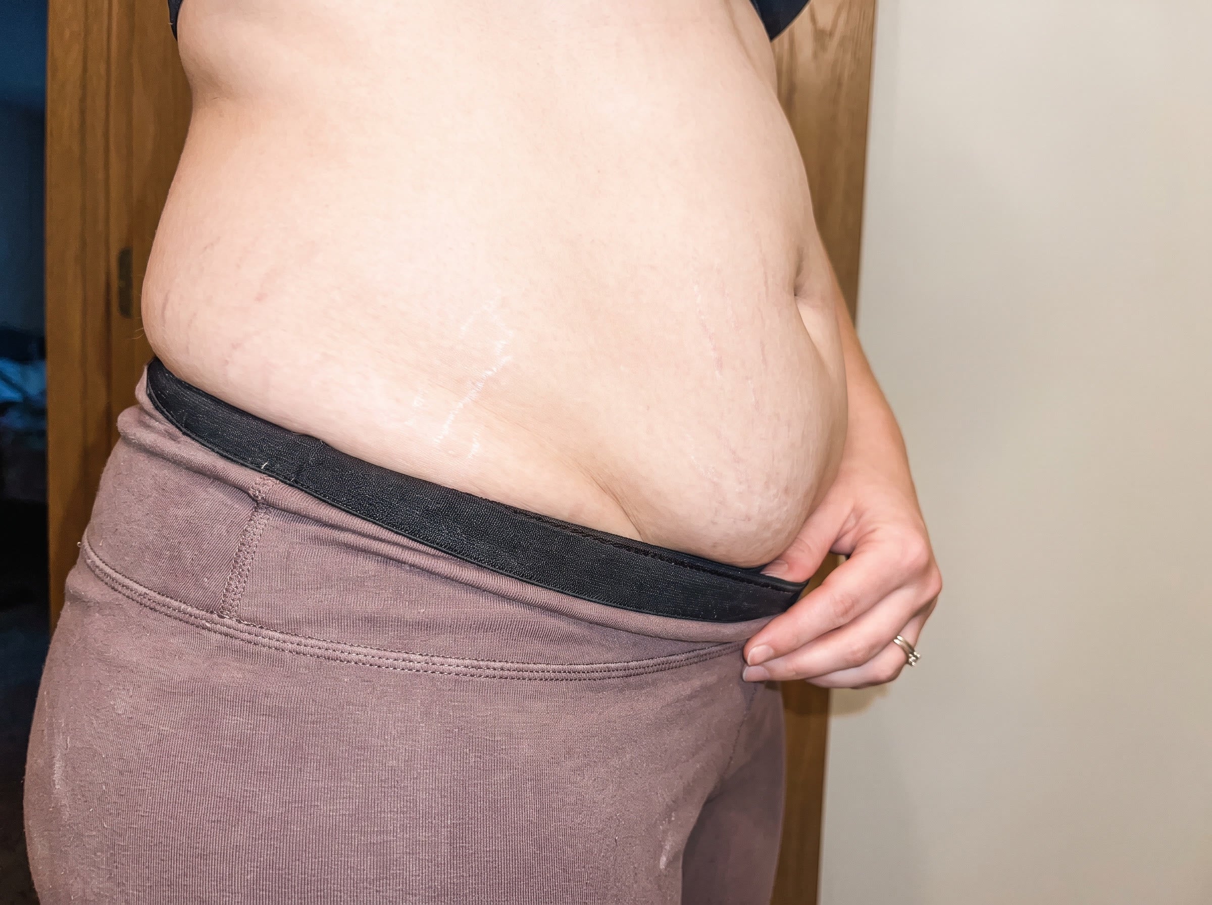 Fat leaves fast. Skin shrinks slow
